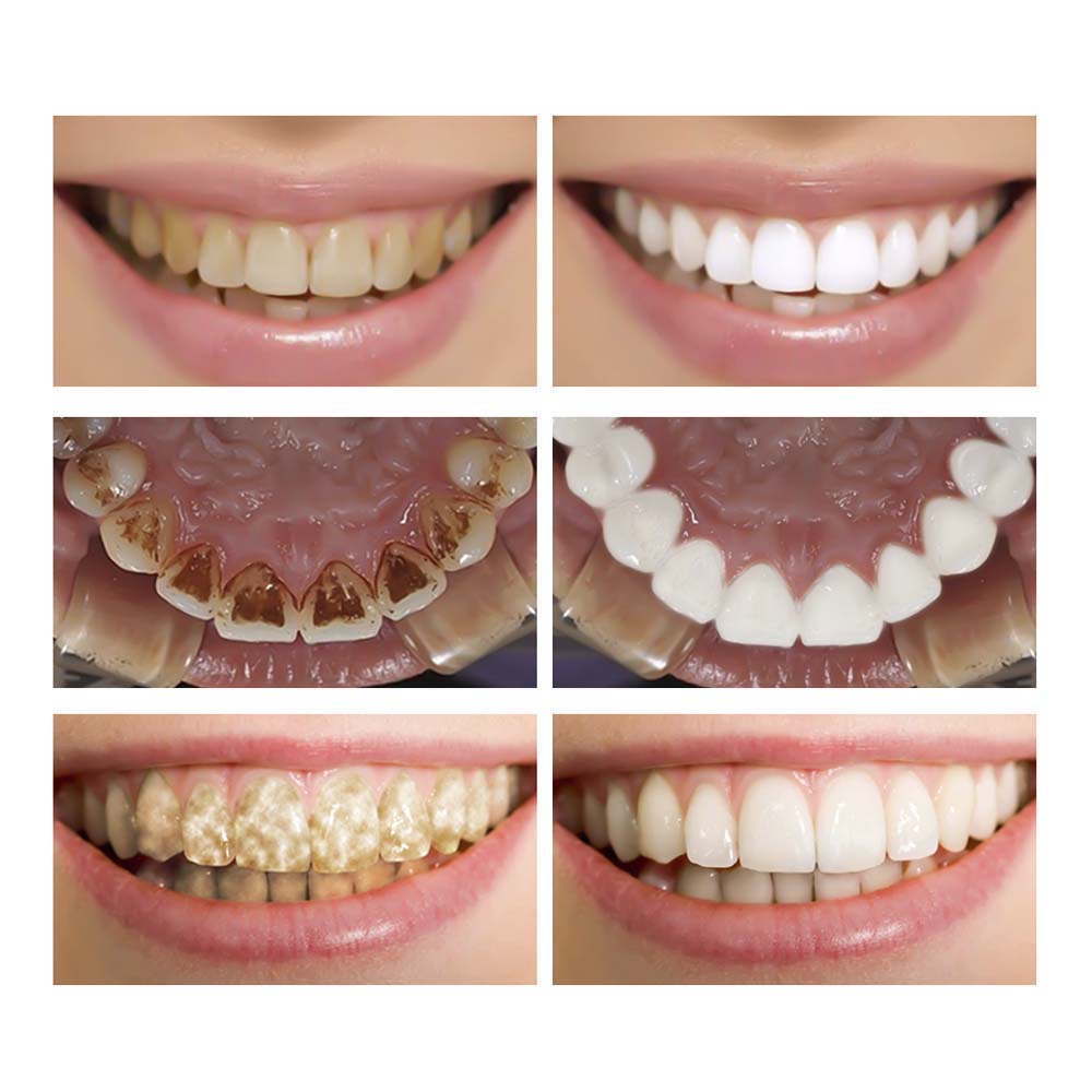 Teeth Whitening Essence